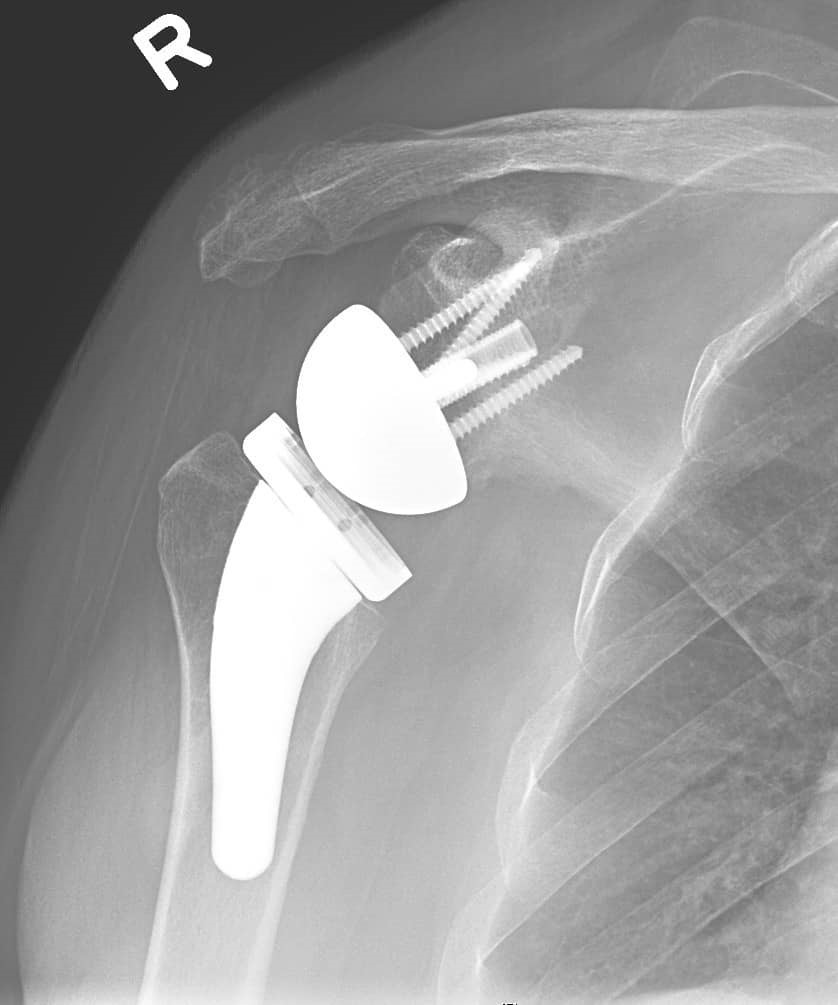 Shoulder Joint Replacement - Rela Hospital